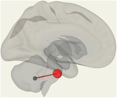 Subcortical and default mode network connectivity is impaired in myalgic encephalomyelitis/chronic fatigue syndrome